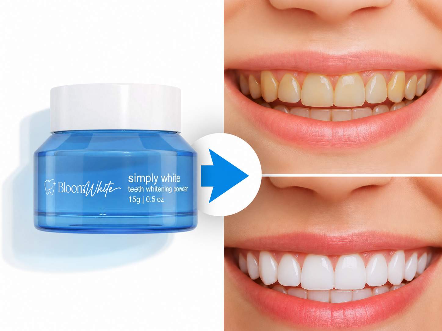 Bloom White Teeth Whitening Results